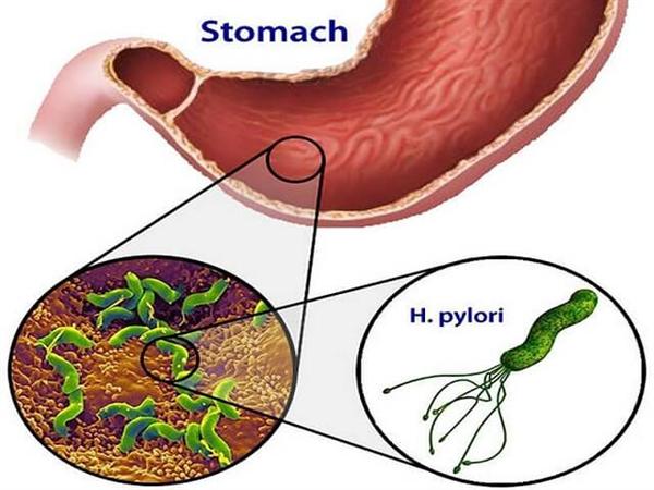 Có thực sự cần phải quá lo lắng với vi khuẩn Helicobacter pylori như vậy không?
