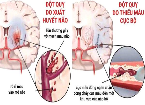 Chăm sóc người bệnh đột quỵ