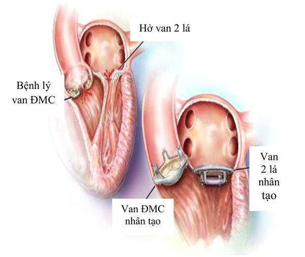 Một số vấn đề cần biết sau phẫu thuật thay van