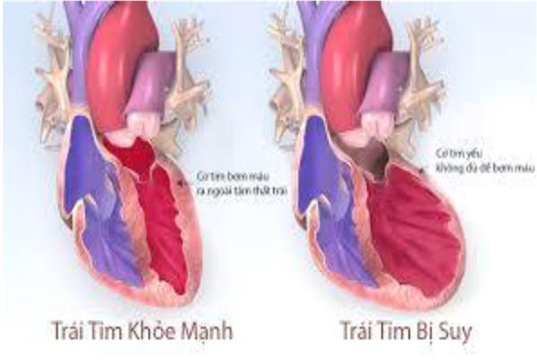 Suy tim - Vấn đề cần được quan tâm