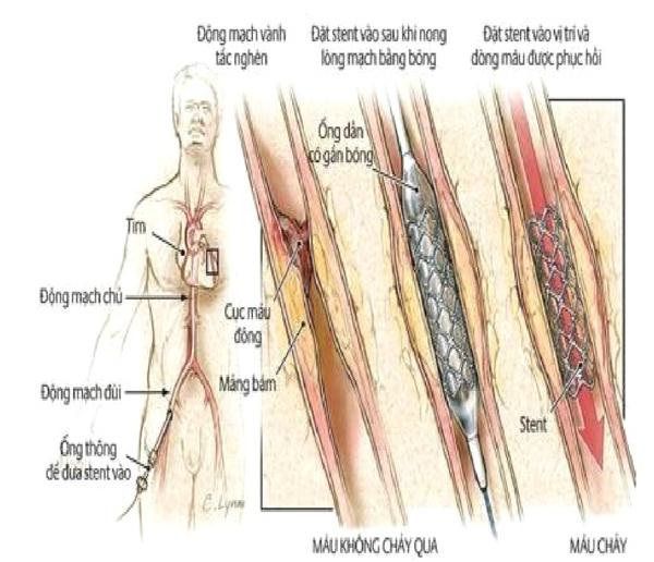 Một số vấn đề cần biết sau đặt stent