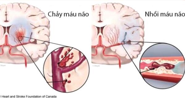 Chẩn đoán và điều trị đột quỵ não