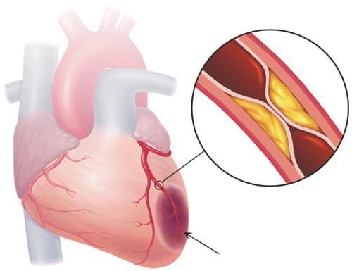 Nguyên nhân nào gây ra bệnh động mạch vành?
